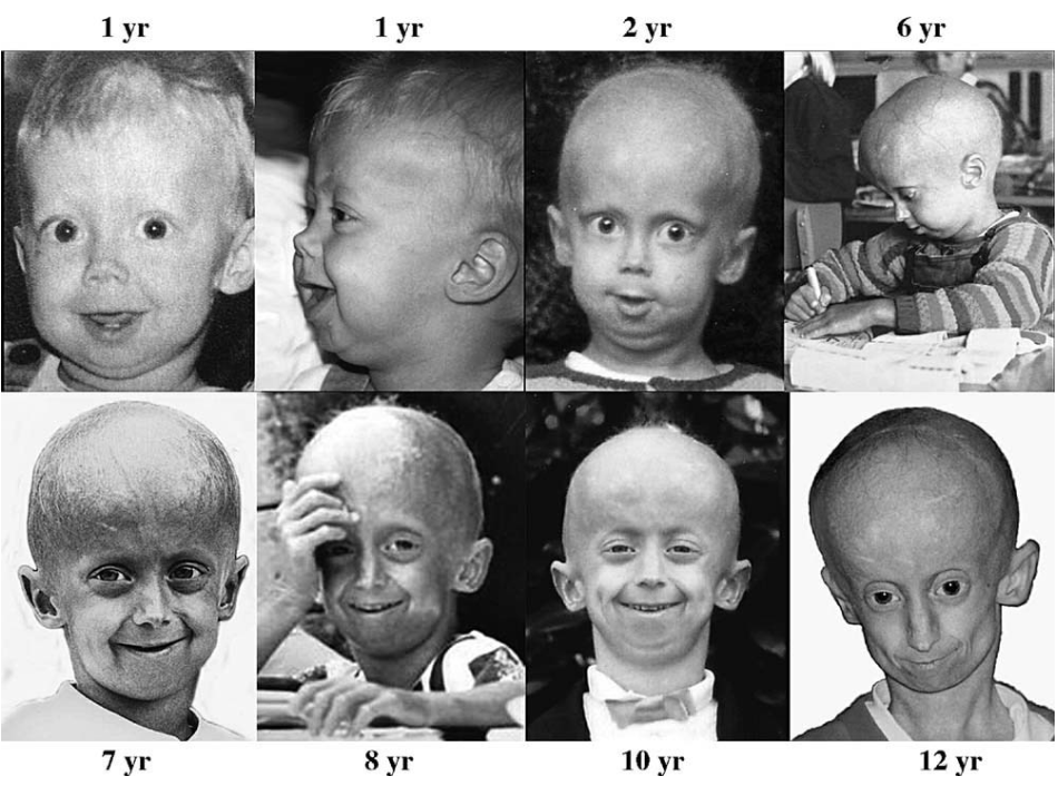 A Look at Progeria: Unpacking the Science of Premature Ageing